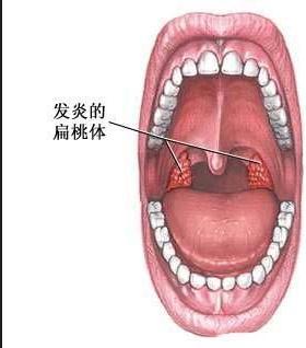 吞咽都感觉费劲疼痛,频频需要喝水保湿,而且是晚间休息时喉咙干痒沙哑