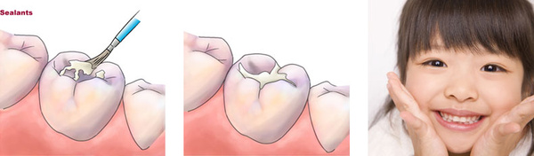 儿童牙齿保护之窝沟封闭