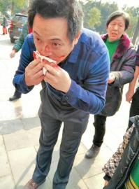 冯老师的鼻梁受伤