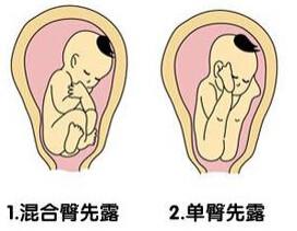 为什么宝宝在肚子里有的是倒立?有的是坐着的
