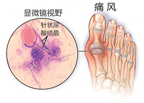 管不好嘴脚受罪:痛风的朋友注意了!