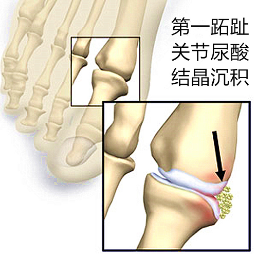 急性痛风性关节炎好发关节是第一跖趾关节,这是因为该处承受行走时最