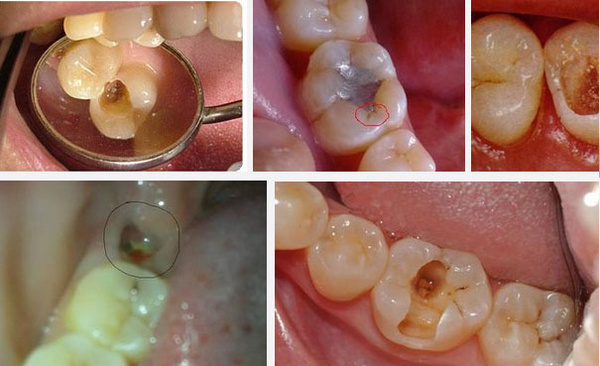 牙洞是怎么造成的以及如何预防