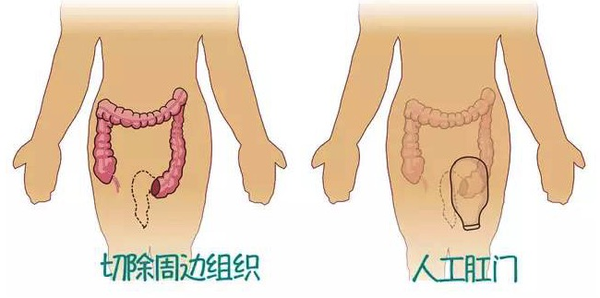 miles手术普遍应用临床,其切除范围广,能性损坏大及永久性肠造口等