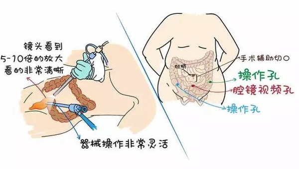 【优医说】李心翔:直肠癌腹腔镜手术助保肛