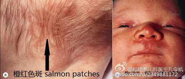 橙红色斑(salmon patches) ●橙红色斑是良性毛细血管畸形,新生儿发病