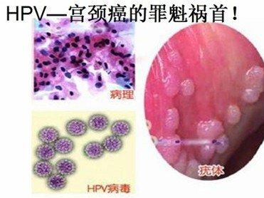 有治疗HPV感染的方法?