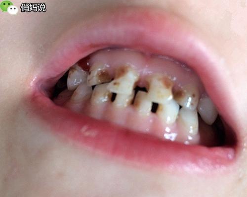小孩7岁了前面的牙没有掉但牙从后面牙出来了怎么办 育儿