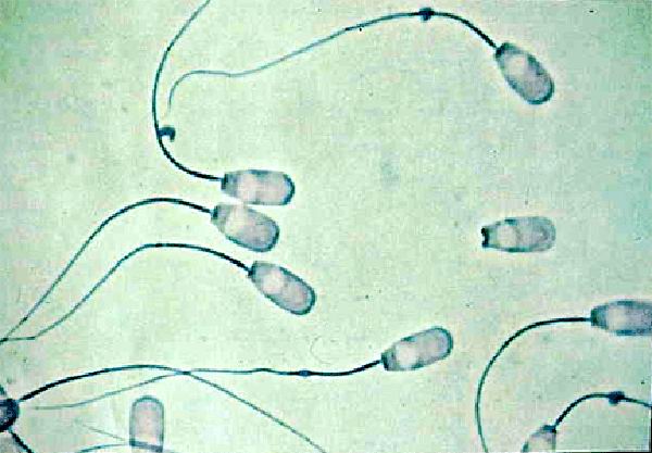 中西医治疗男性精子畸形的方法