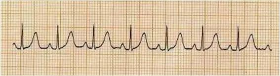 行善堂/解读心电图报告,探知窦性心动过速的"秘密"