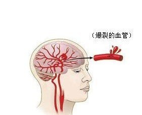 飙高音飙出脑出血,了解预防不可少