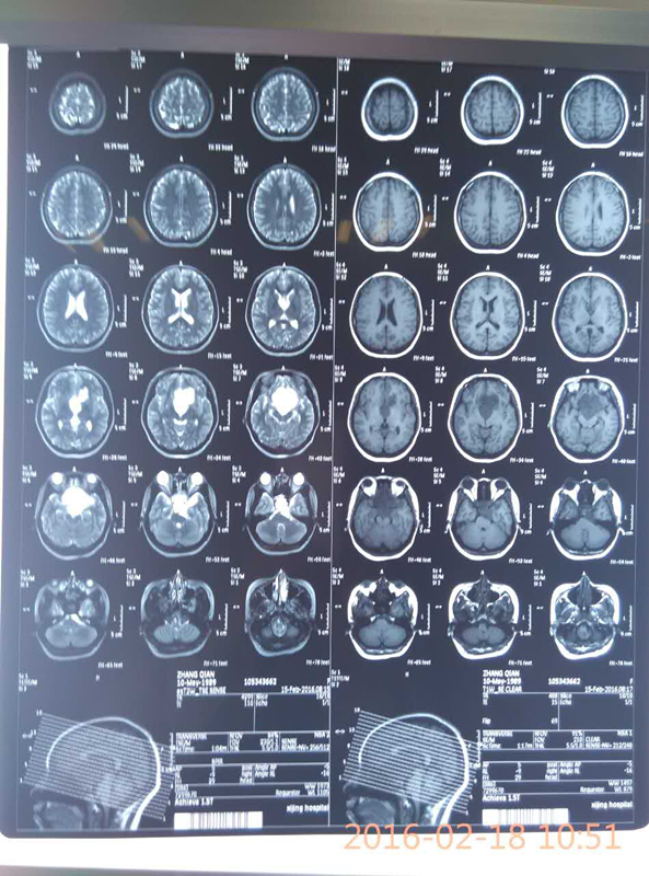 鞍区囊性占位,考虑囊肿,皮样囊肿或胶样囊肿可能性大,考虑为良性脑膜