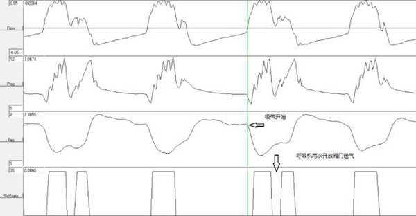 脉搏搏动等波形震荡频率相对比,在一例脑死亡患者的呼吸机波形图中