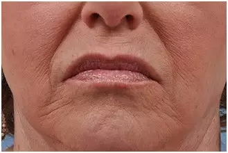 口皱纹属于静态皱纹,如果嘴角的皮肤开始松弛,就有向下的趋势.