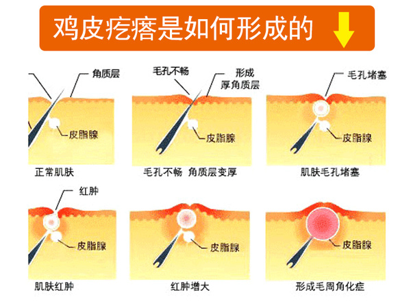 鸡皮肤到底是怎么形成的,怎么样可以去掉