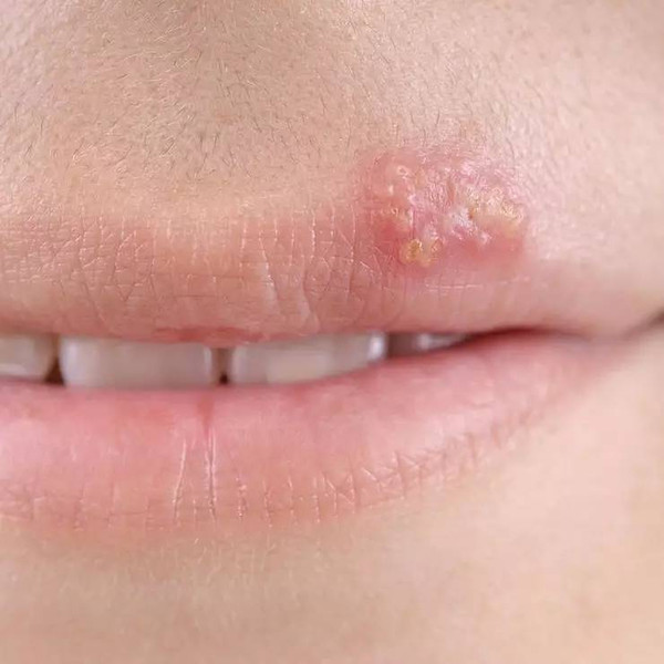 唇疱疹是由单纯疱疹病毒所引起的急性疱疹性皮肤病.