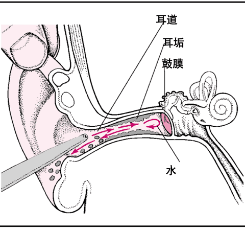 三个月宝宝耳朵进水怎么办