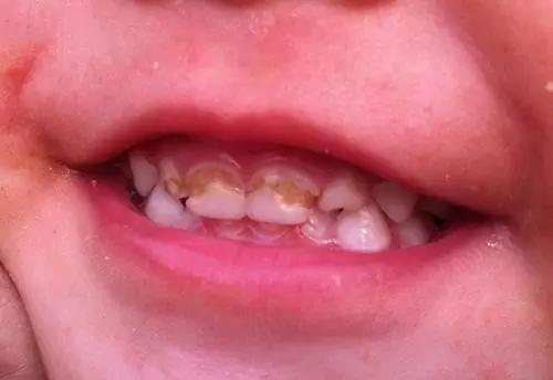 这是一个不到2周岁宝宝的牙齿,可以看到里面的两颗磨牙已经出现了明显