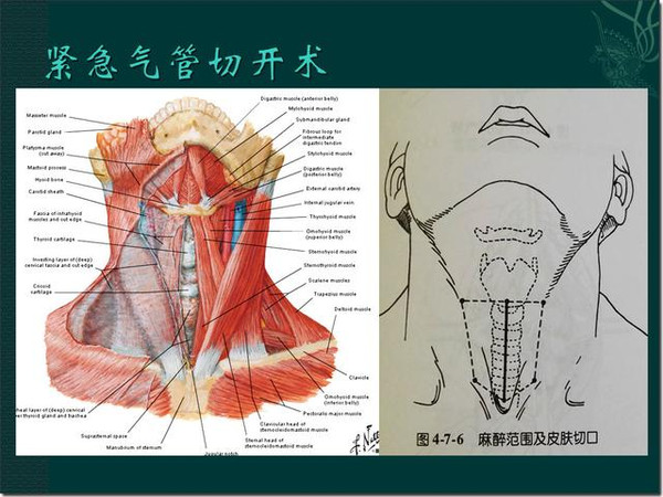 急性喉梗阻诊治