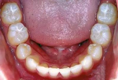 由于没有替换掉任何牙齿,很多爸爸妈妈都以为六龄牙是乳牙,即使坏