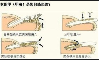 预防灰指甲,专家教你几招