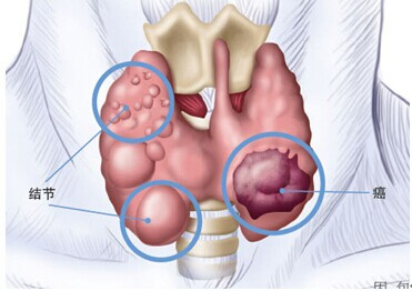 今年54岁的沈阿姨,一年前,被诊断为甲状腺右叶结节.