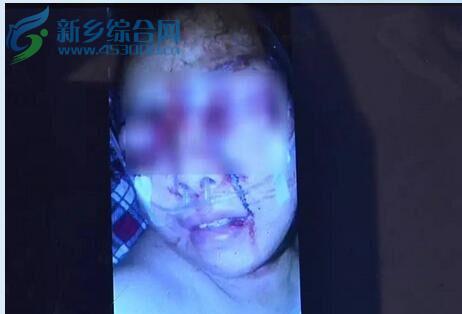 新乡丈夫挖掉妻子双眼 可怜3个孩子和妈妈相依为命