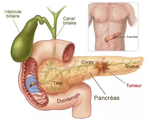 绝大部分的胰腺癌病人有上腹部或后背部疼痛,体重在短时间内明显下降.