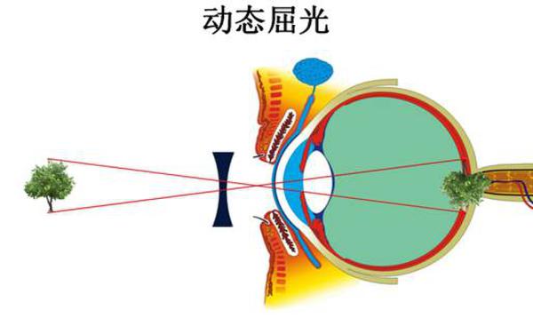 健视加云+智能眼镜:杭州近视眼矫正进入非手