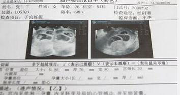 怀孕一个月得知是3胞胎,B超结果却让人担心