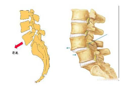 腰椎滑脱的6个主要症状,你有没有?