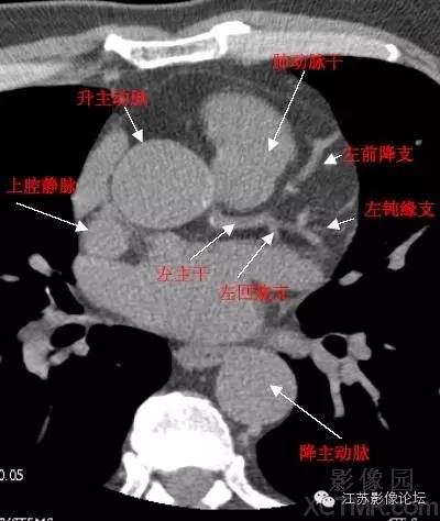 带你全面了解心脏冠状动脉ct解剖