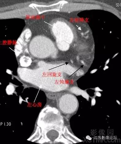 带你全面了解心脏冠状动脉ct解剖