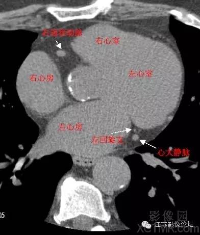 带你全面了解心脏冠状动脉ct解剖