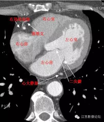 带你全面了解心脏冠状动脉ct解剖