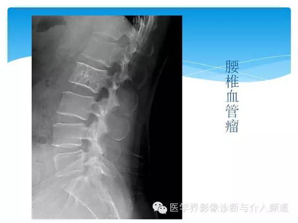 这些骨肿瘤你都看得懂吗?