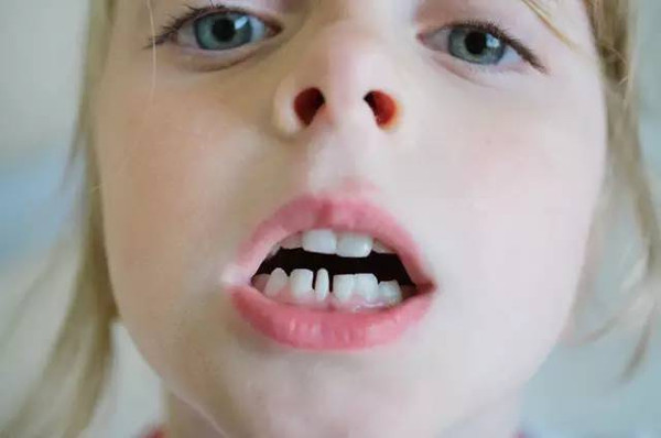 小心这些异常"毁了"孩子的牙齿