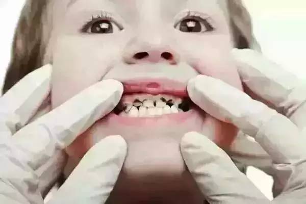 小心这些异常"毁了"孩子的牙齿