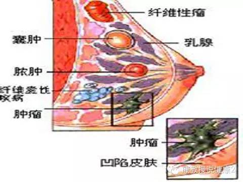 呈 片状或细颗粒,结节状,增厚区与周围乳腺组织分界不明显;有时 两侧