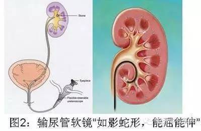 【新技术新业务】泌尿外科输尿管软镜技术