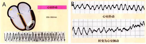 需要注意的是,室扑很少自行恢复,几乎不可避免演变成室颤(图 2b).