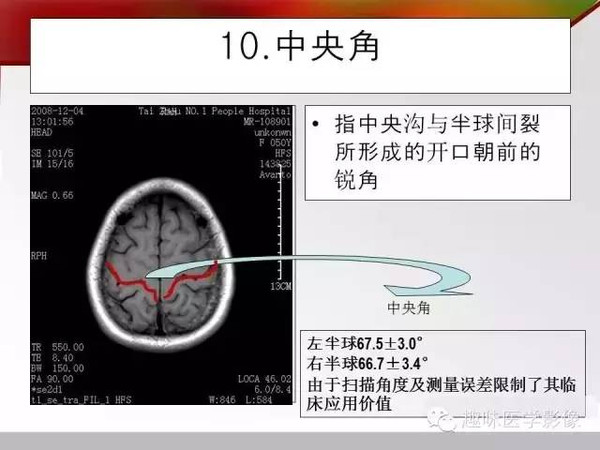 值得收藏,横断面脑沟回十大征象