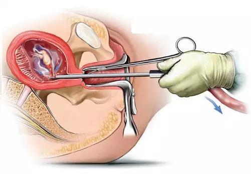 人工流产 人工流产的刮宫会损伤子宫内膜基底层,引起内膜损伤和宫腔