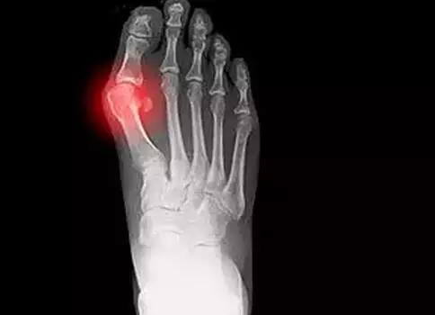 2 大脚趾突然增大   可能是痛风,关节炎的一种,通常由过多尿酸