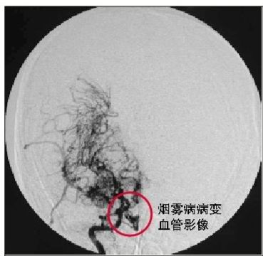 烟雾病(moyamoya病)的自然史