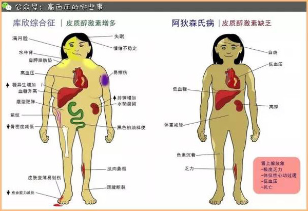 皮质醇增多症与高血压有什么关系?