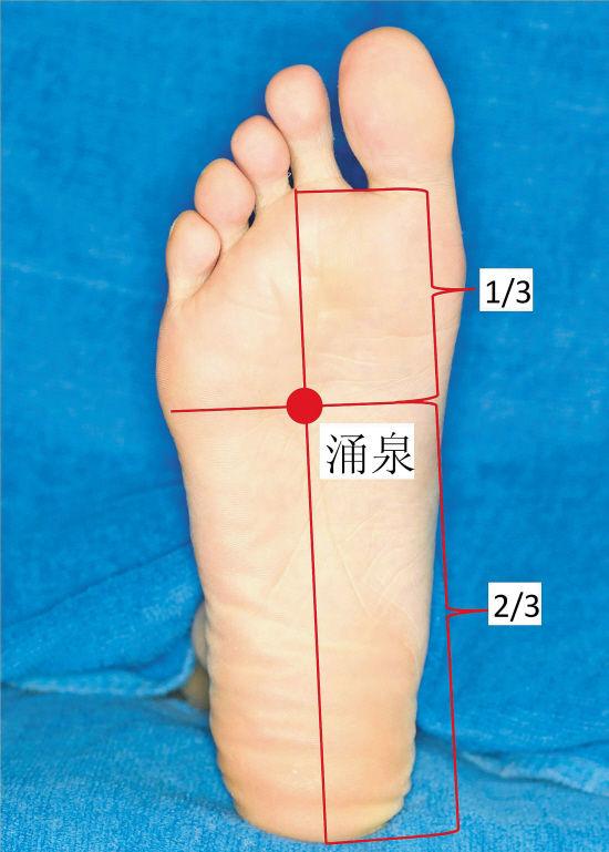 在脚心涌泉穴糊上大蒜泥,左侧鼻出血糊在左脚心,右侧鼻出血糊在右脚心