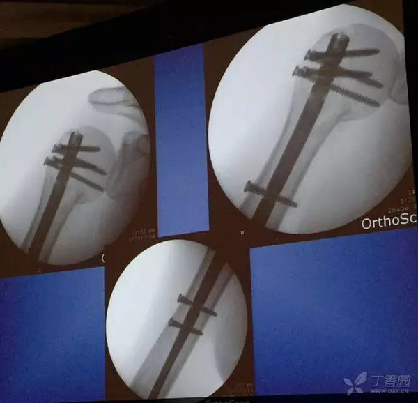 aaos 2016:肱骨近端骨折 使用髓内钉的优势及技巧