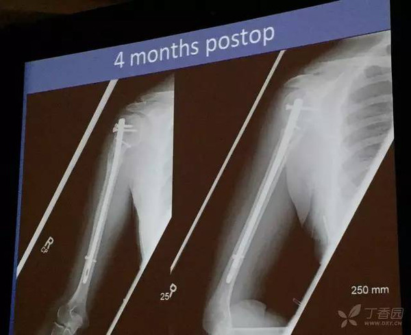 aaos 2016:肱骨近端骨折 使用髓内钉的优势及技巧_手机搜狐网