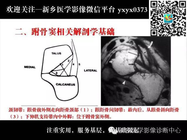 全面了解跗骨窦综合征